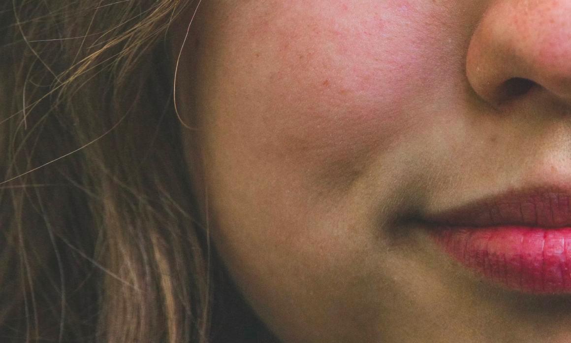 Rougeurs cutanées au visage : Conseils & remèdes naturels contre l’érythème facial